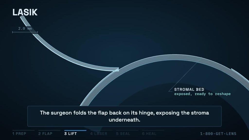 LASIK cross-section: the corneal flap folded back on its hinge, exposing the stromal bed
