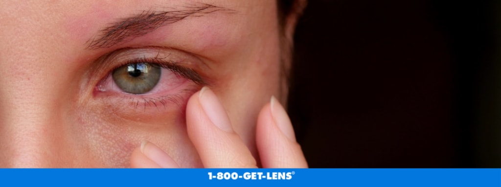 Woman with red irritated eye