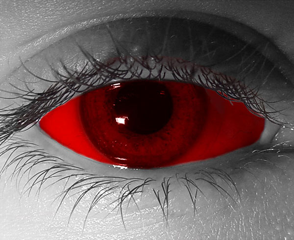 Red Sclera